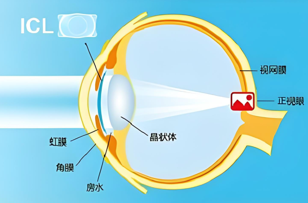 为什么ICL晶体大光学区这么“V5”？ - 广州普瑞眼科医院