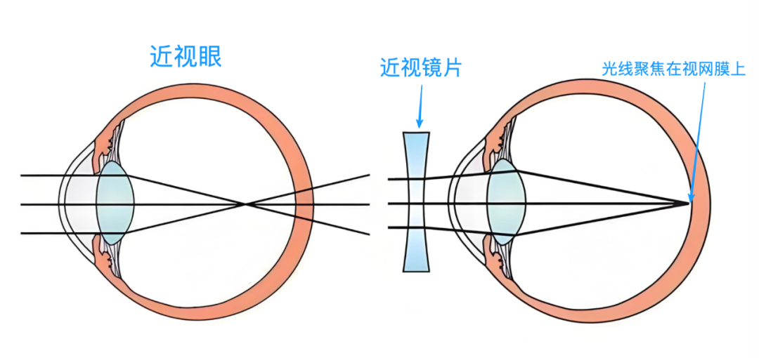 离了个大谱，没近视却戴眼镜10多年！猜，结果怎么样？ - 广州普瑞眼科医院