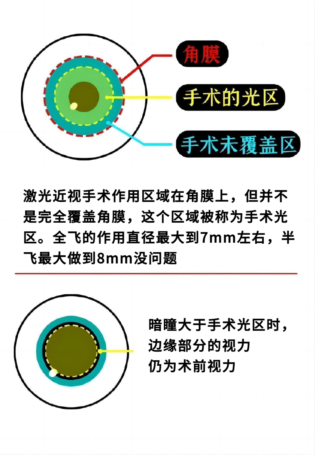 暗瞳大,一定做不了近视手术吗? - 广州普瑞眼科医院