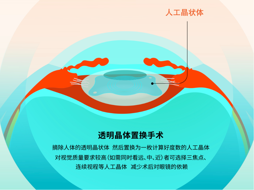 又近视又老花,能在角膜上同时矫正吗? - 广州普瑞眼科医院