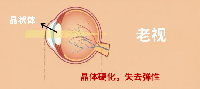 做完近视手术，老花会提前找上门？真相是这样的… - 广州普瑞眼科医院