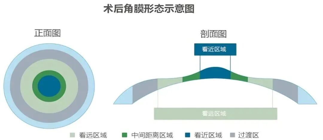 又近视又老花,能在角膜上同时矫正吗? - 广州普瑞眼科医院