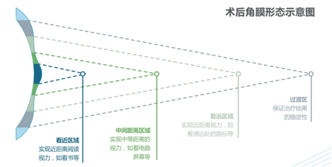 又近视又老花,能在角膜上同时矫正吗? - 广州普瑞眼科医院
