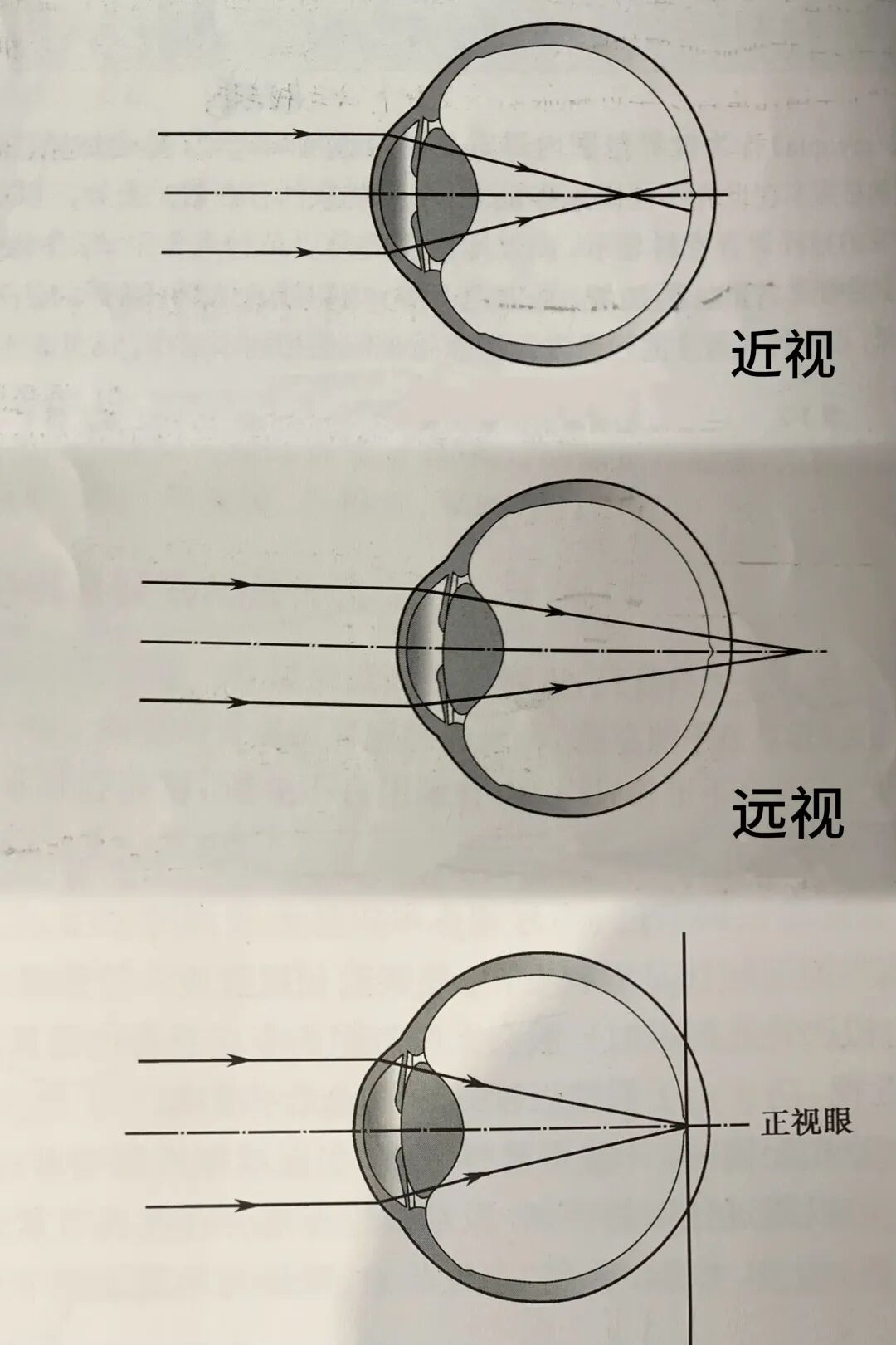 原来不是一回事!度数≠视力,科学区分打破误区 - 广州普瑞眼科医院