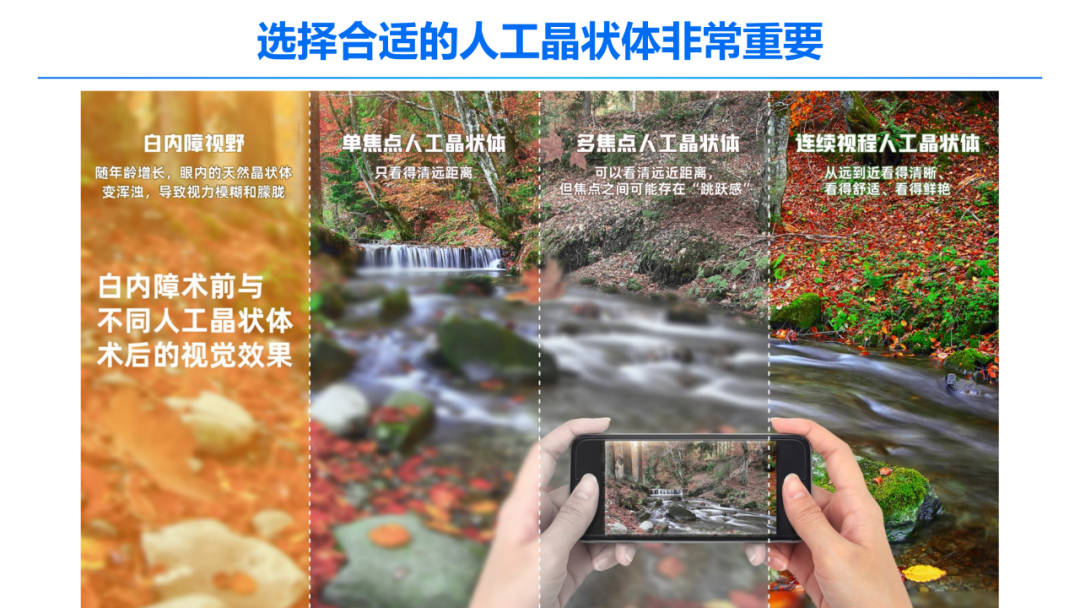有钱任性?白内障手术选晶体,你就非要选那最贵的? - 广州普瑞眼科医院