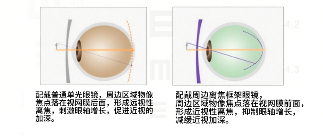 怕选错离焦镜坑娃?医学验光配镜,用专业给孩子视力上 “保险” - 广州普瑞眼科医院