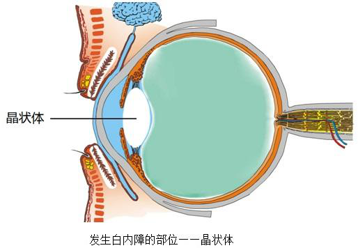 双眼都有白内障,到底先做哪只? - 广州普瑞眼科医院