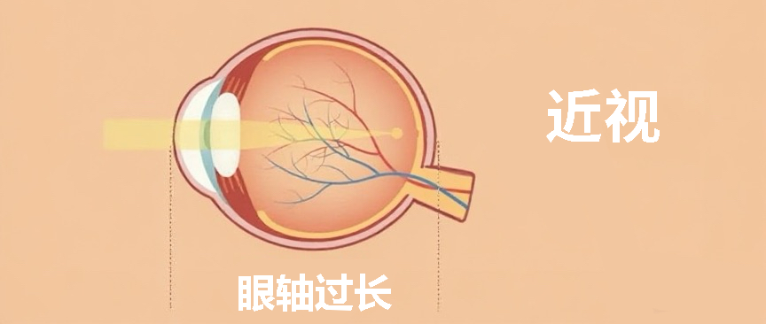 做完近视手术，老花会提前找上门？真相是这样的… - 广州普瑞眼科医院
