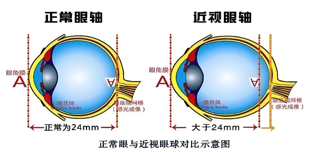 冷知识,一个人的近视度数有没有上限? - 广州普瑞眼科医院