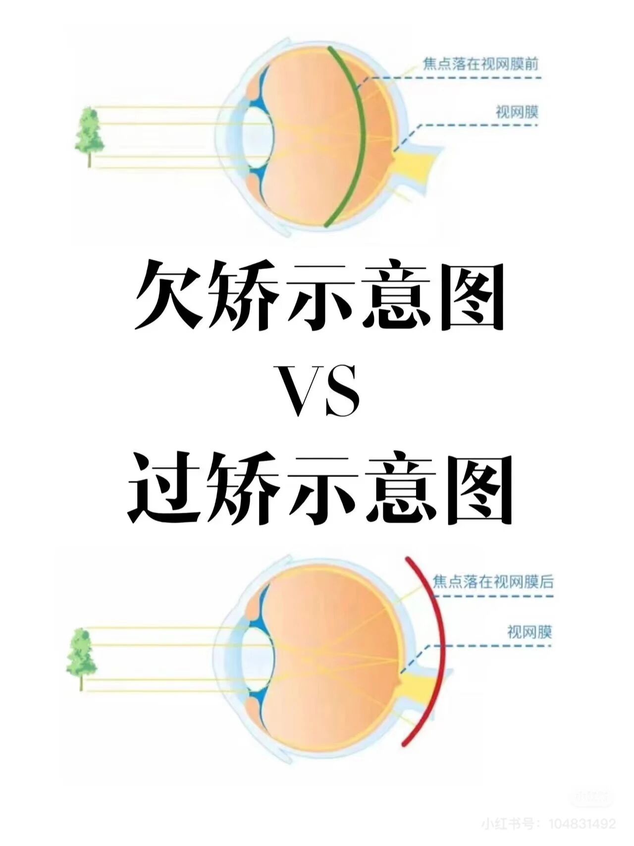 别让看得“更清楚”伤了眼睛！ - 广州普瑞眼科医院