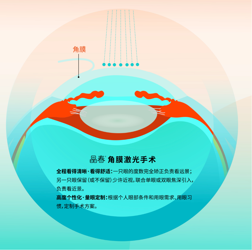 又近视又老花,能在角膜上同时矫正吗? - 广州普瑞眼科医院
