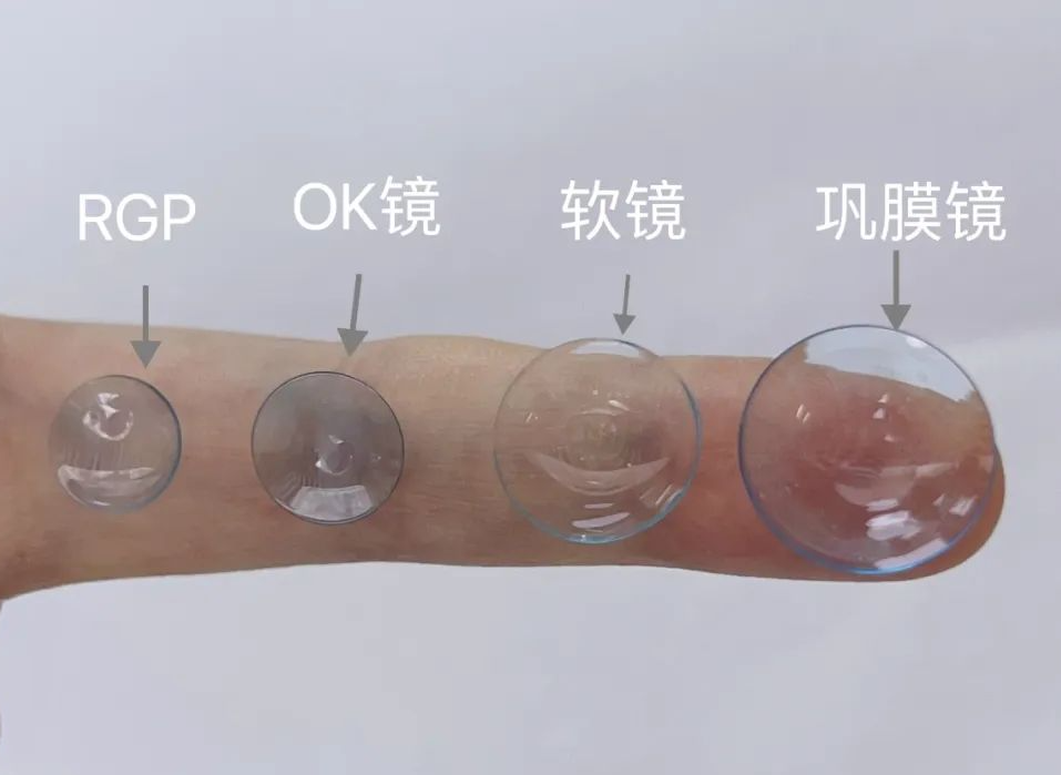 RGP总是掉,视觉质量不好怎么办?可以试试巩膜镜 - 广州普瑞眼科医院