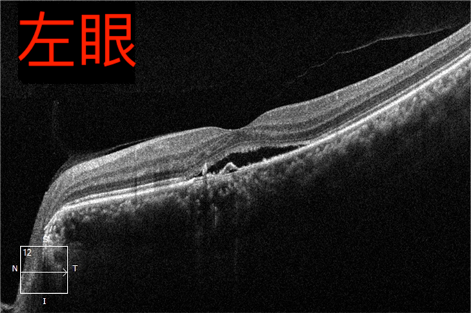 眼病科普系列之——“中浆病”(一) - 广州普瑞眼科医院