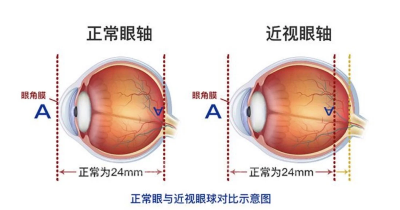 青少年近视真的可以“退轴”吗?科学解读眼轴增长的真相 - 广州普瑞眼科医院