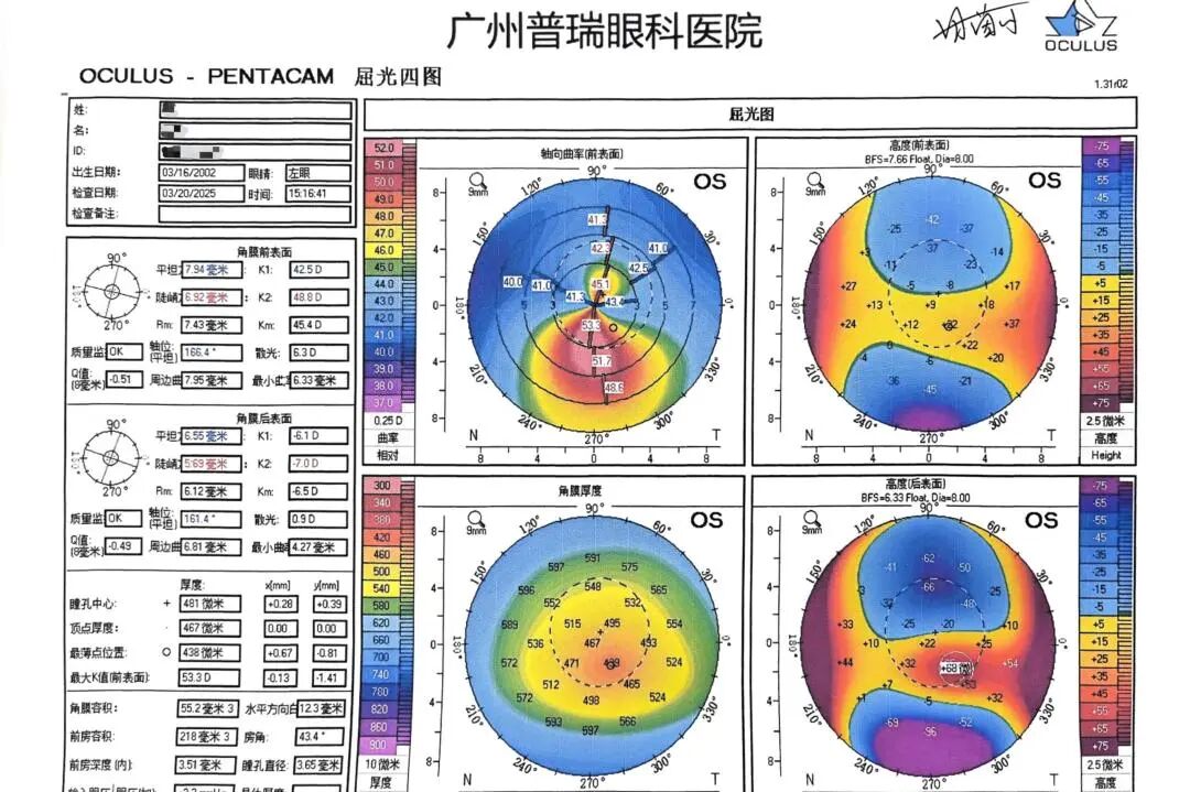 RGP总是掉,视觉质量不好怎么办?可以试试巩膜镜 - 广州普瑞眼科医院