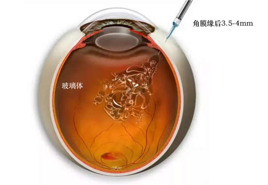 震惊!你知道吗?原来眼睛也能打针! - 广州普瑞眼科医院