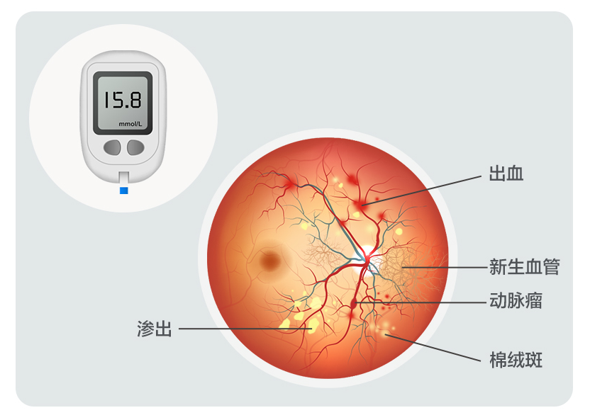 共防“甜蜜”视力杀手 —— 11.14糖尿病日眼科健康宣教活动 - 广州普瑞眼科医院