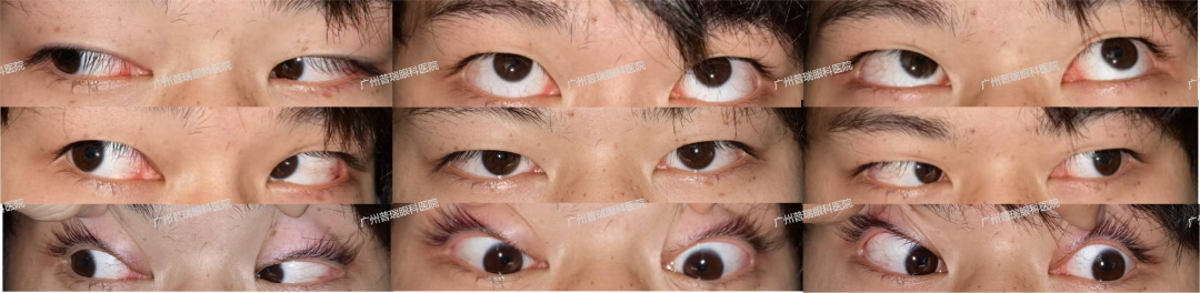 惊！玩手机竟把眼睛玩“歪”了，这些习惯你也有吗？ - 广州普瑞眼科医院