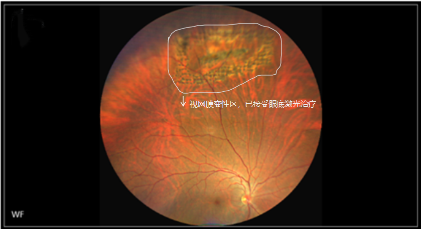 想摘镜却发现“眼底有个洞”?能做近视手术吗 - 广州普瑞眼科医院