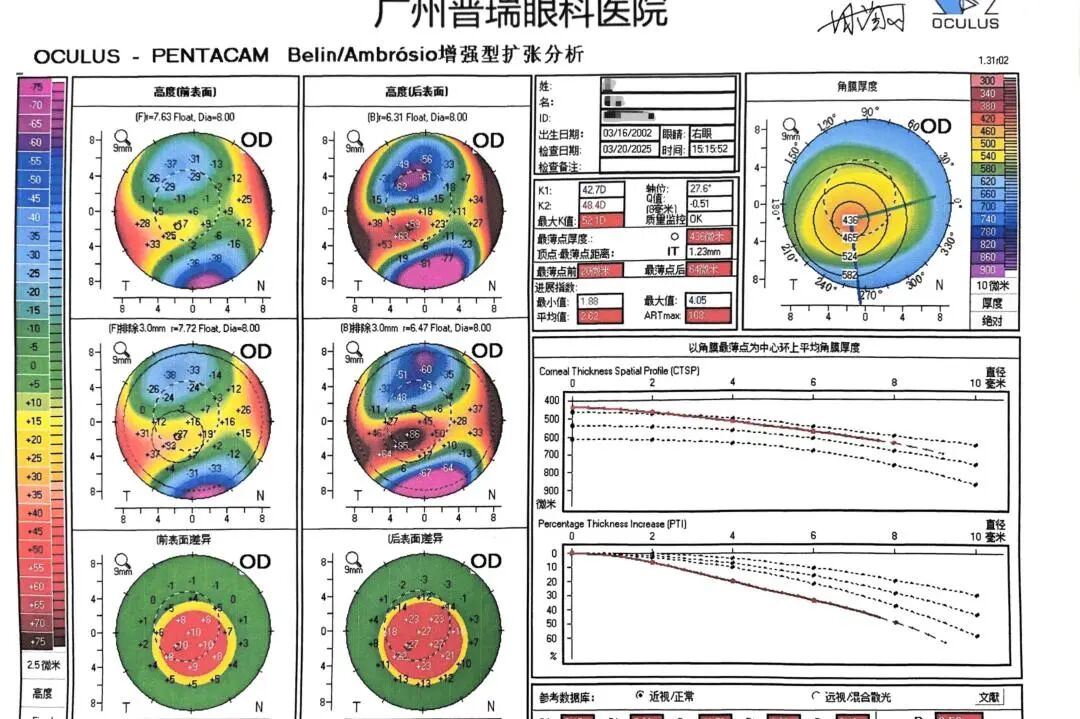RGP总是掉,视觉质量不好怎么办?可以试试巩膜镜 - 广州普瑞眼科医院