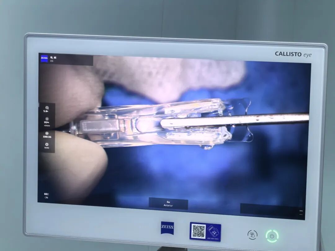 国内首例！2300度超高度近视患者龙晶®PR型晶体“双眼四襻同步植入”成功摘镜 - 广州普瑞眼科医院