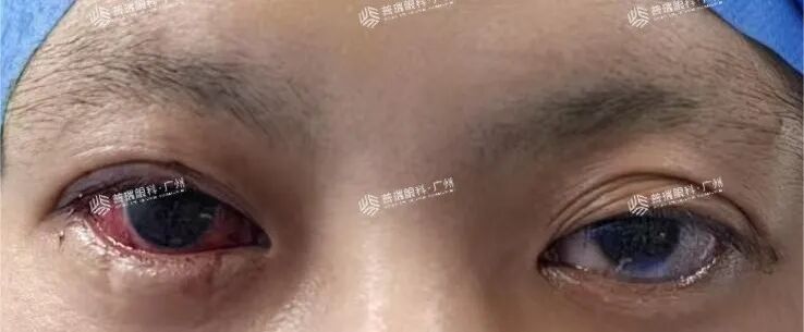 三十而“愈”,她成功挥别斜视阴霾 - 广州普瑞眼科医院