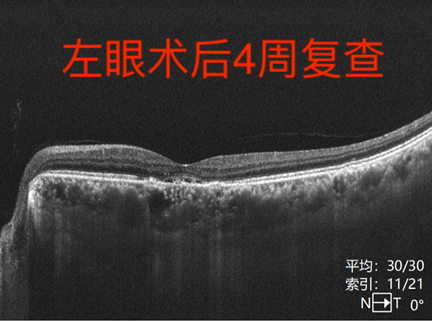 眼病科普系列之——“中浆病”(一) - 广州普瑞眼科医院