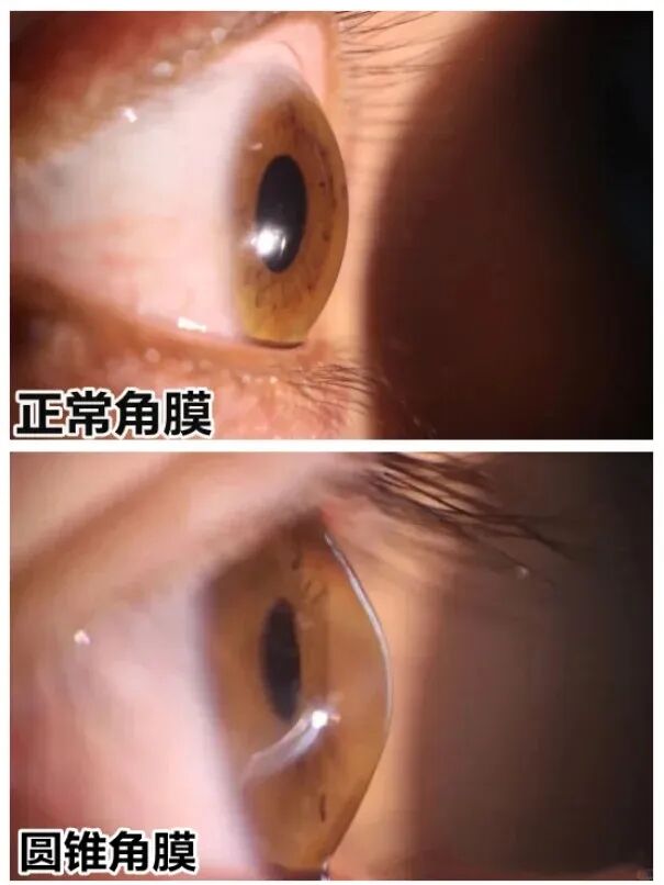 跨越七百公里的光明接力:湖南患者在广州成功接受角膜移植手术 ! - 广州普瑞眼科医院
