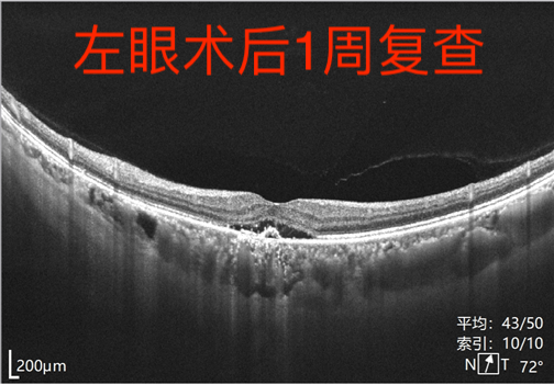 眼病科普系列之——“中浆病”(一) - 广州普瑞眼科医院