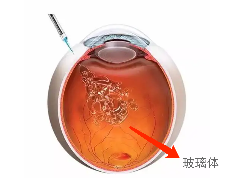 眼病科普系列之——“中浆病”（三） - 广州普瑞眼科医院