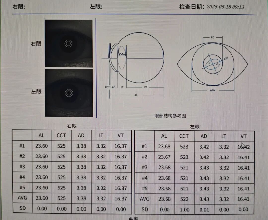 【视光案例】危险的屈光参差!13岁少年近视单眼暴涨75度 - 广州普瑞眼科医院