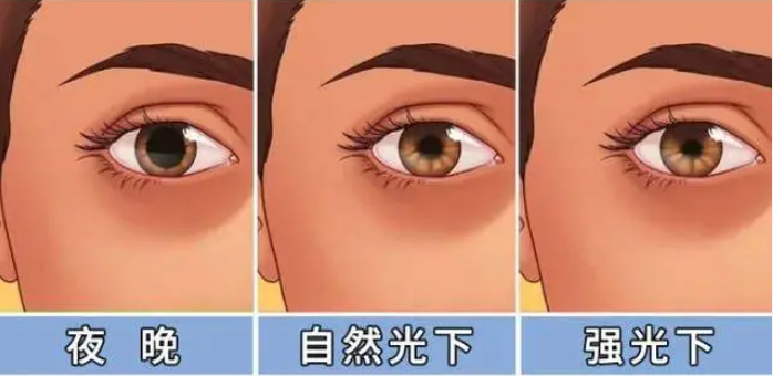 暗瞳太大不能做近视手术?外籍演员达丽雅弃“暗”投明成功摘镜 - 广州普瑞眼科医院
