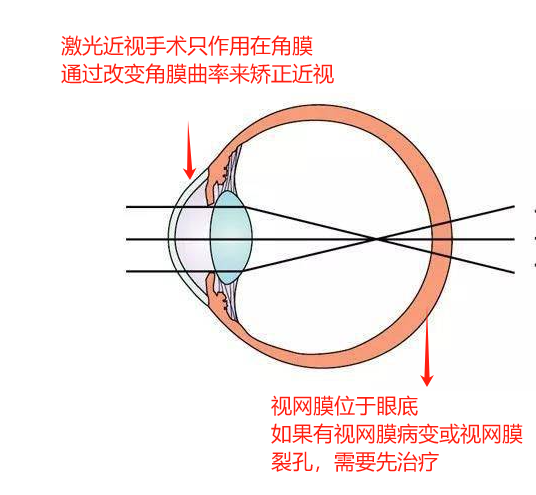 想摘镜却发现“眼底有个洞”?能做近视手术吗 - 广州普瑞眼科医院