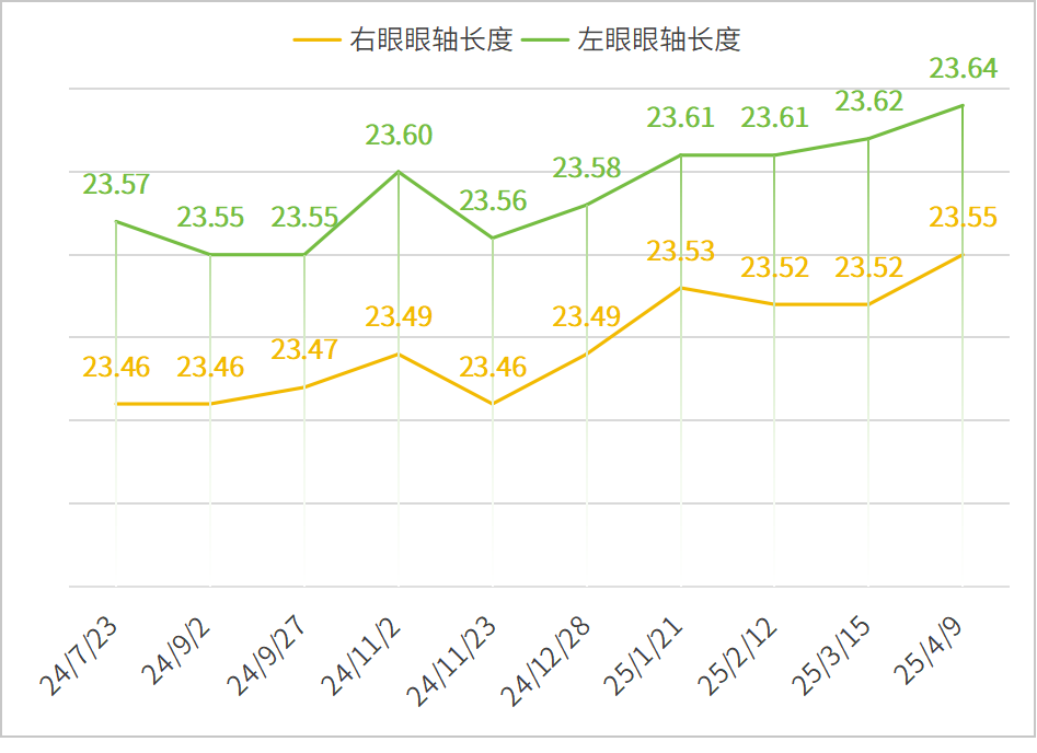 青少年近视真的可以“退轴”吗?科学解读眼轴增长的真相 - 广州普瑞眼科医院