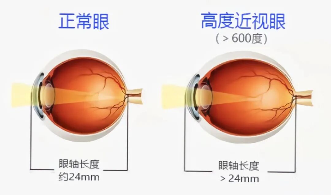 一位眼科教授的选择:为高度近视的女儿选择屈光矫正手术医院 - 广州普瑞眼科医院