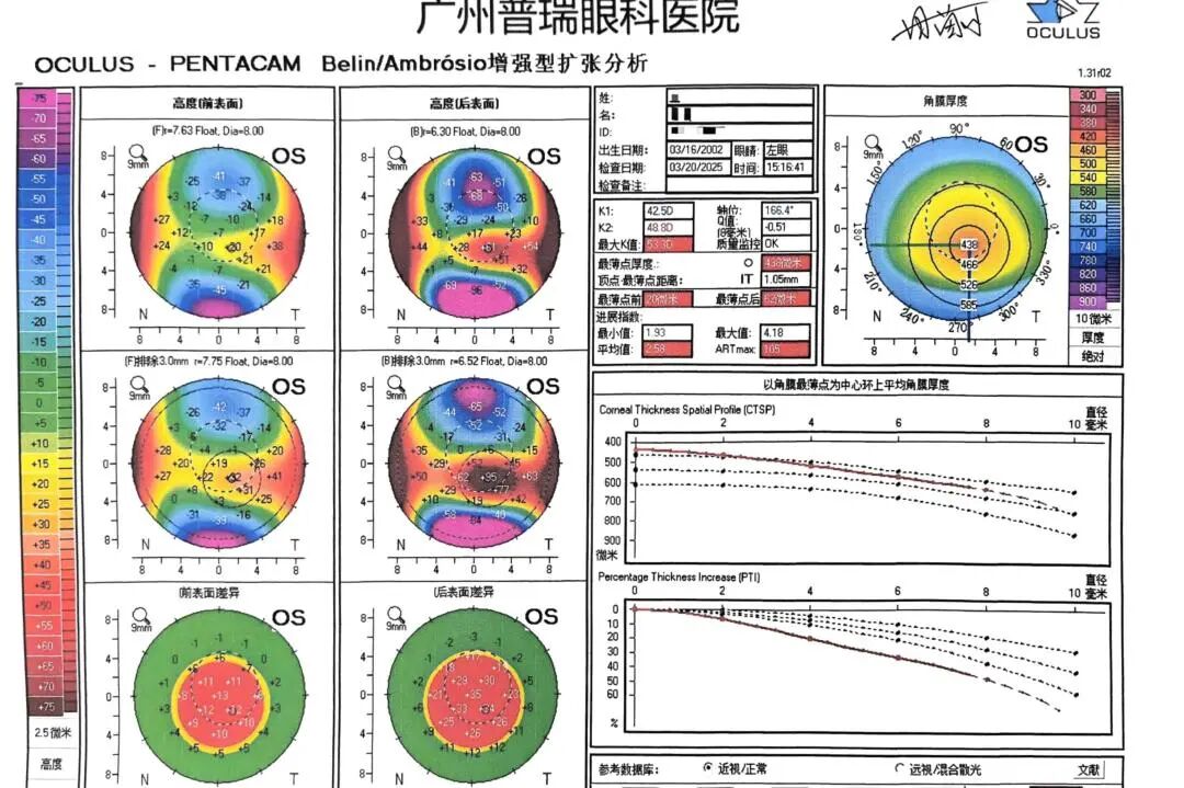 RGP总是掉,视觉质量不好怎么办?可以试试巩膜镜 - 广州普瑞眼科医院