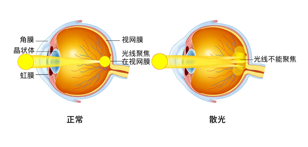 三维一体近视管理|除了近视,这个问题也让无数孩子戴上眼镜 - 广州普瑞眼科医院