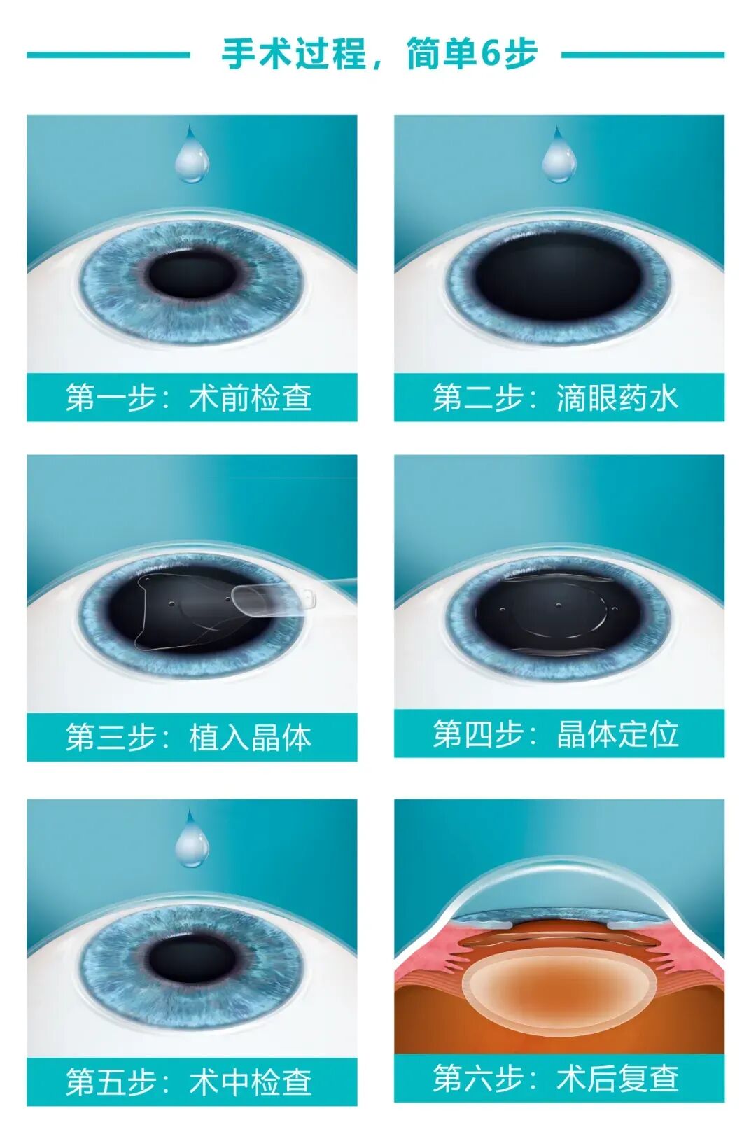 一文带你探秘高度近视摘镜黑科技 ——ICL 晶体植入术 - 广州普瑞眼科医院