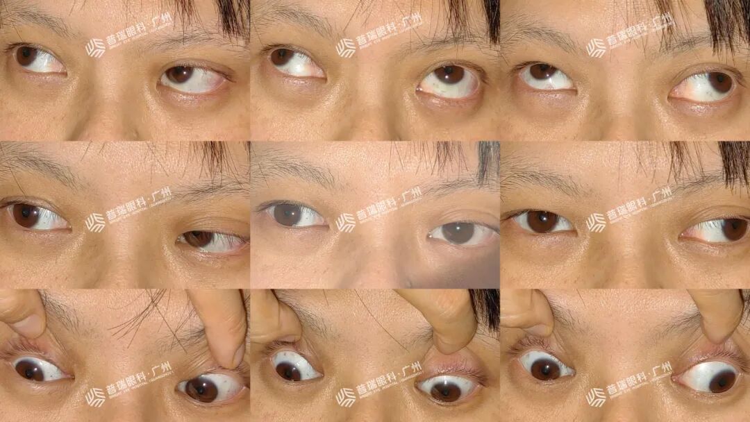三十而“愈”,她成功挥别斜视阴霾 - 广州普瑞眼科医院