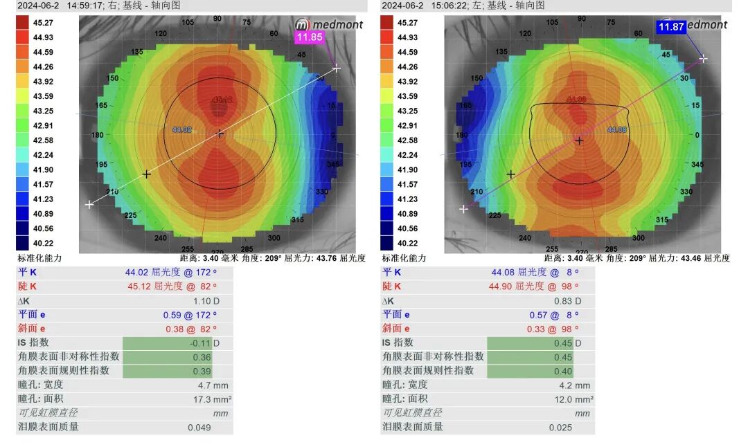 【视光案例】危险的屈光参差!13岁少年近视单眼暴涨75度 - 广州普瑞眼科医院
