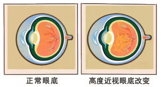 想摘镜却发现“眼底有个洞”?能做近视手术吗 - 广州普瑞眼科医院