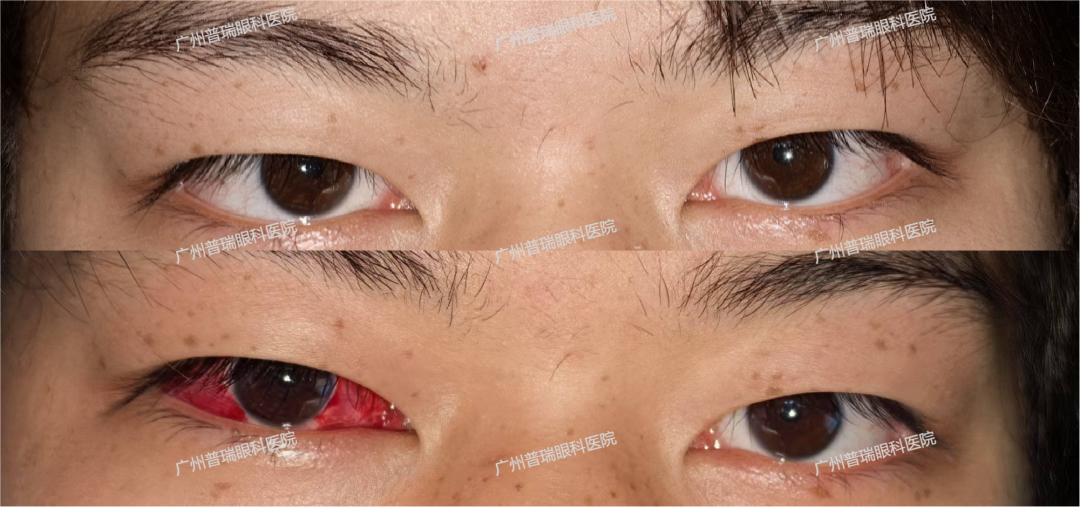 惊！玩手机竟把眼睛玩“歪”了，这些习惯你也有吗？ - 广州普瑞眼科医院