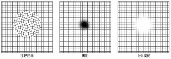 眼病科普系列之——“中浆病”(二) - 广州普瑞眼科医院