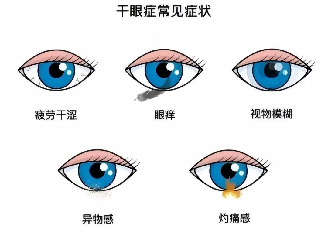 被 “干” 扰到崩溃?拒绝欲哭无泪 - 广州普瑞眼科医院