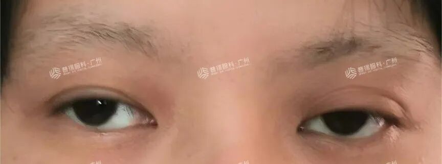 三十而“愈”,她成功挥别斜视阴霾 - 广州普瑞眼科医院
