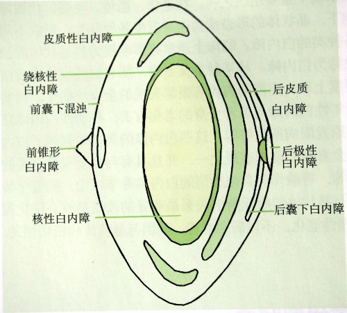 人老了,头发会变白,眼睛会出现 “ 白内障 ” ? - 广州普瑞眼科医院
