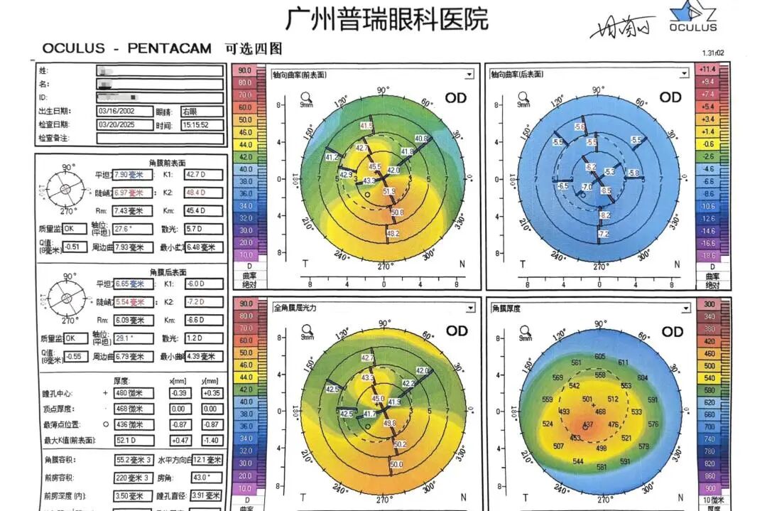 RGP总是掉,视觉质量不好怎么办?可以试试巩膜镜 - 广州普瑞眼科医院