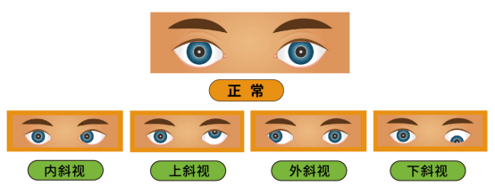 孩子斜视手术前,你需要知道的 | 岳以英教授 5 月 7-8 日广州普瑞眼科亲诊亲术 - 广州普瑞眼科医院