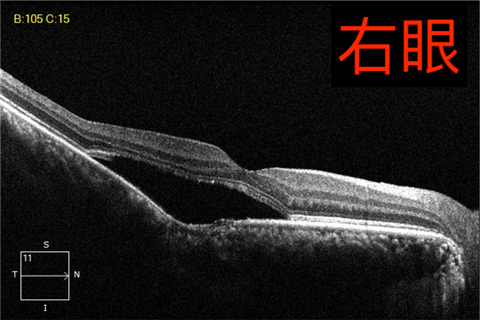 眼病科普系列之——“中浆病”(一) - 广州普瑞眼科医院