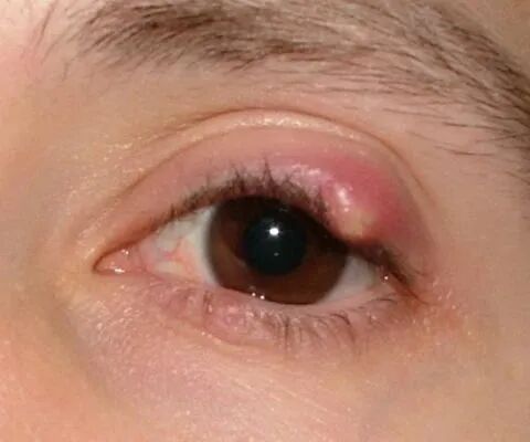 6种常见眼病,看看你有没有这些症状? - 广州普瑞眼科医院